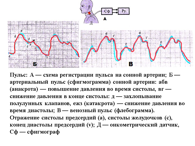 Пульс: А — схема регистрации пульса на сонной артерии; Б — артериальный пульс (сфигмограмма)